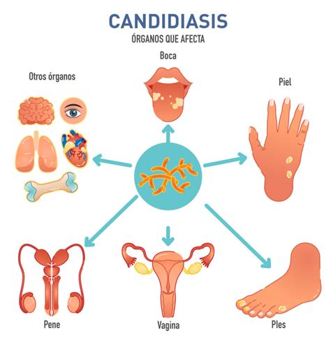 Factores que influyen en la candidiasis vaginal