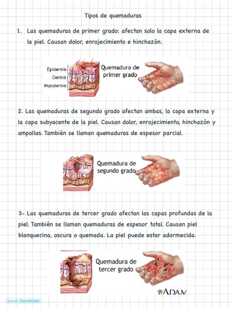 Tipos de quemaduras y sus características