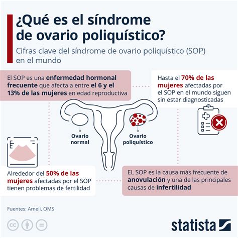 Infografía sobre el Síndrome de Ovario Poliquístico