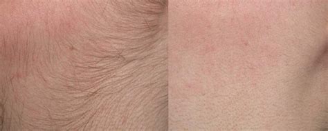 Mujer con acné y vello facial
