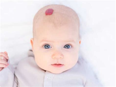 Tratamiento de hemangiomas infantiles