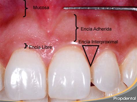 Tipos de encías según su color