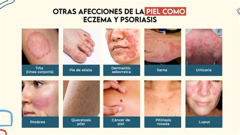 Persona con eccema en la piel