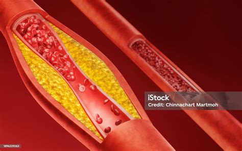 Imagen de una arteria con acumulación de calcio y grasa