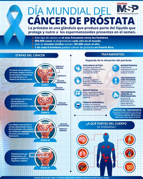 Infografía sobre el cáncer de próstata y sus factores de riesgo