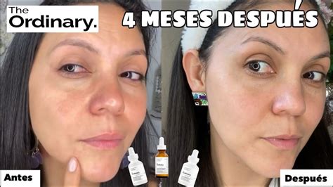 Comparativa de piel antes y después del uso de niacinamida para manchas