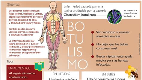 Infografía sobre los síntomas del botulismo