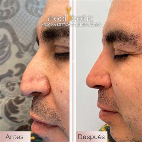 Antes y después de rinomodelación masculina con ácido hialurónico