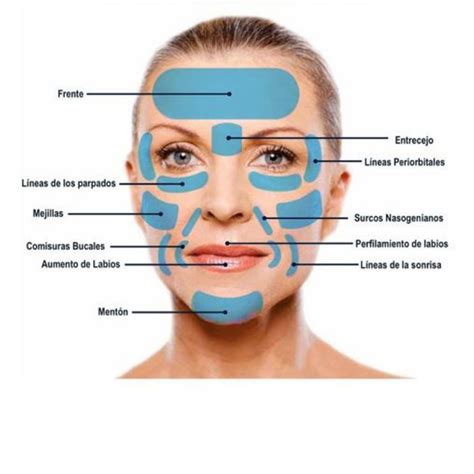 Zonas de aplicación de ácido hialurónico para reducir arrugas masculinas