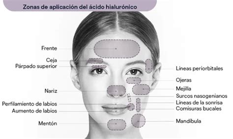Diagrama de puntos de inyección de ácido hialurónico en el rostro masculino