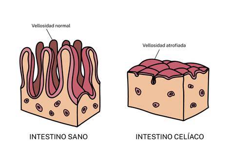 Comparación entre intestino sano y intestino de una persona con enfermedad celíaca