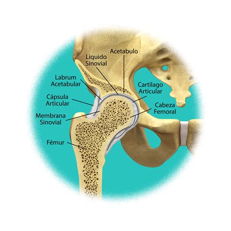 Esquema de la articulación de la cadera sana y con artrosis