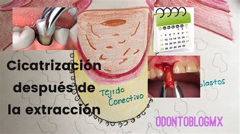 Esquema del proceso de cicatrización de una extracción dental