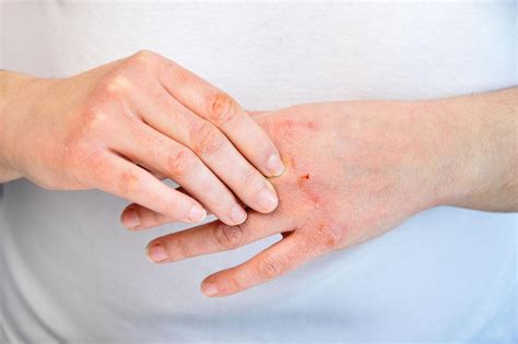 Manos secas y agrietadas antes y después del uso de crema