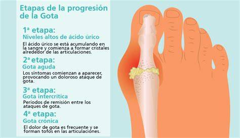 Ilustración de las articulaciones afectadas por la gota