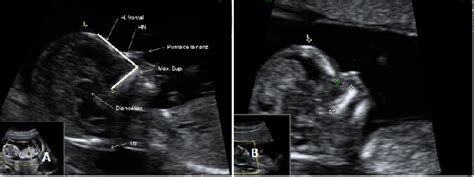 Ecografía fetal donde se aprecia el hueso nasal