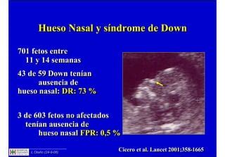 Tabla comparativa de presencia/ausencia de hueso nasal en fetos con y sin trisomía 21