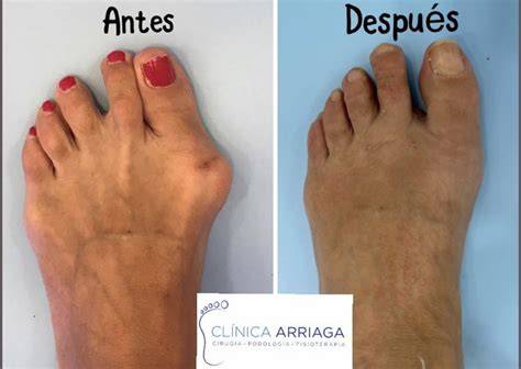 Pies con juanetes y dedos deformados
