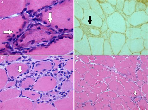 Miopatía vacuolar en biopsia muscular