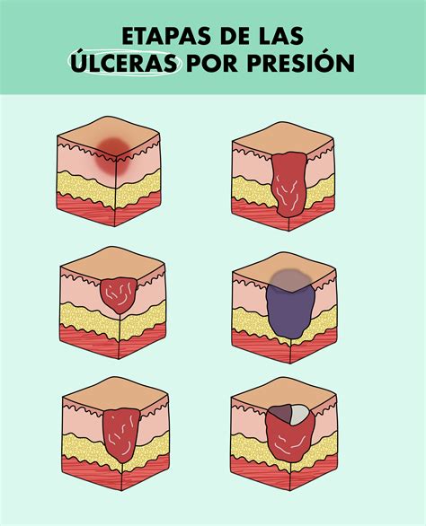 Tipos de úlceras por presión y su localización