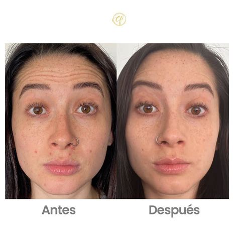 Antes y después del uso de exfoliante facial