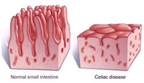 Diferencias entre intestino sano e intestino celíaco