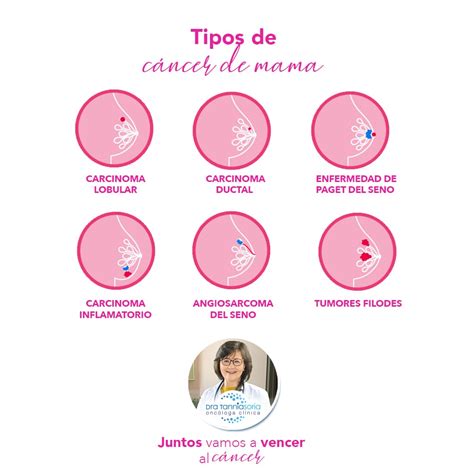Estructura de la mama y tipos de cáncer de mama