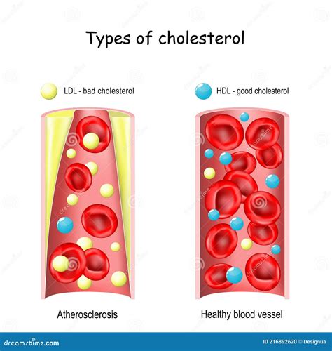 Ilustración comparativa de colesterol bueno (HDL) y malo (LDL)