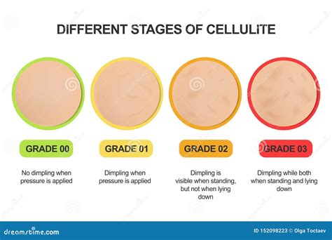 Esquema de las etapas de la celulitis