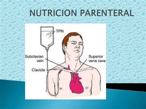 Esquema de nutrición parenteral en niños