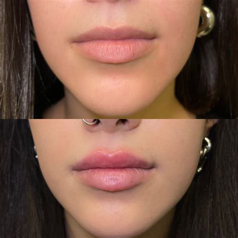 Esquema de las zonas de infiltración en el relleno de labios