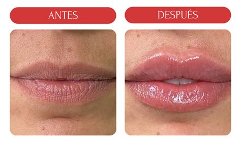 Representación de los efectos del ácido hialurónico en los labios