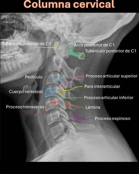 Radiografía de cuello mostrando una costilla cervical