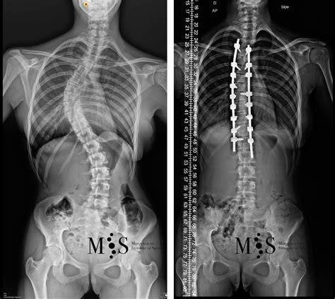 Columna vertebral con escoliosis