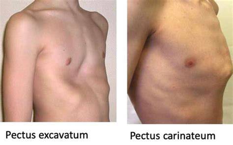 Comparación de Pectus Excavatum y Pectus Carinatum