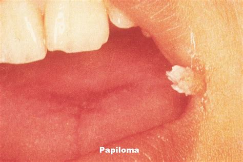 Lesión de papiloma escamoso con aspecto de coliflor