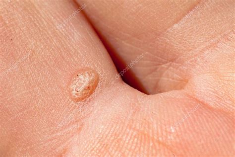 Verrugas comunes en los dedos de la mano