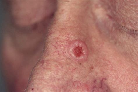 Carcinoma Basocelular nodular ulcerado en la cara