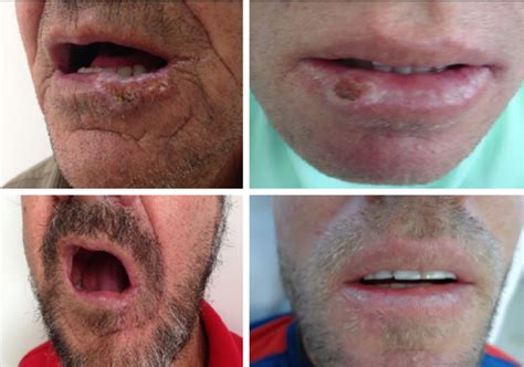 Carcinoma Espinocelular ulcerado en el labio inferior
