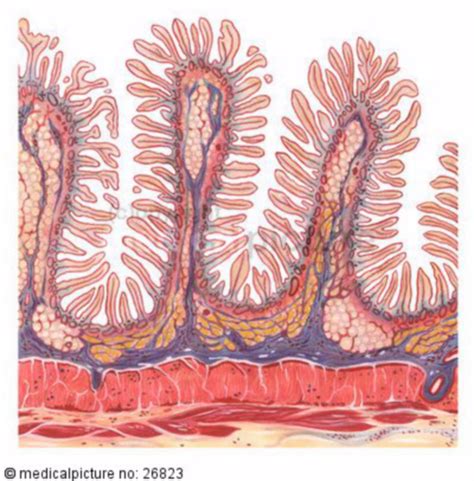 Representación esquemática del intestino delgado con vellosidades dañadas por la enfermedad celíaca.