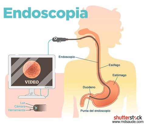 Ilustración de una endoscopia digestiva alta para biopsia intestinal.