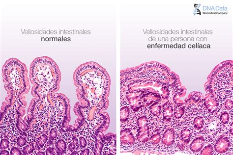Micrografía de las vellosidades intestinales dañadas por el gluten