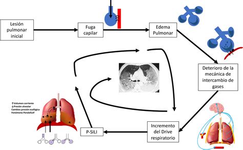 Esquema de las principales localizaciones de aire torácico extrapulmonar