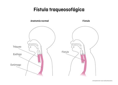 Diagrama de una fístula traqueoesofágica