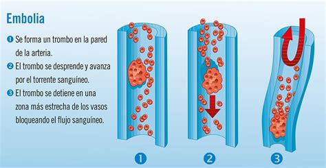 Representación de una embolia venosa aérea en el corazón