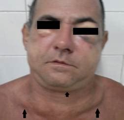 Ilustración de enfisema subcutáneo en el cuello y tórax