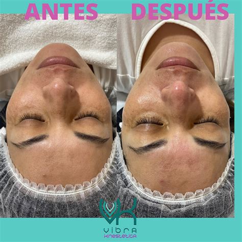 Comparativa de limpieza facial antes y después