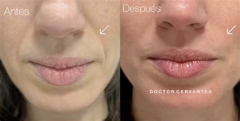 Tratamiento de pliegues nasolabiales con relleno
