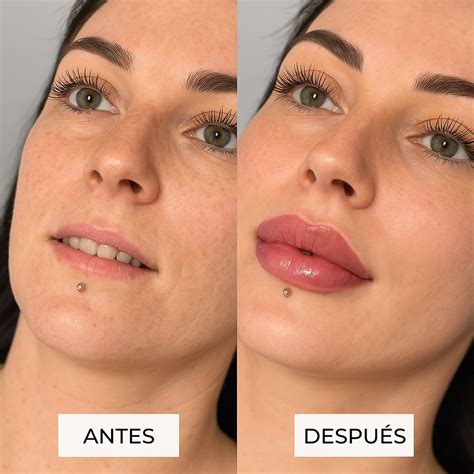 Aumento de labios con rellenos