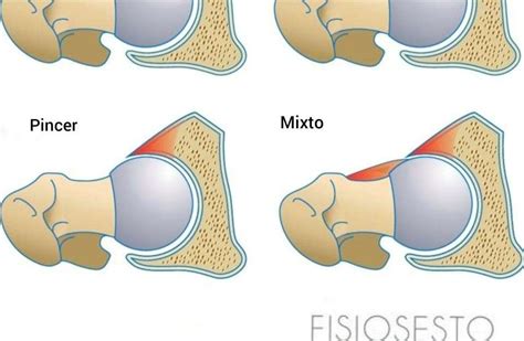 Esquema del atrapamiento femoroacetabular tipo Pincer